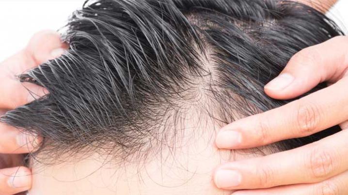 Erzurum Saç Kök Hücre Tedavisi